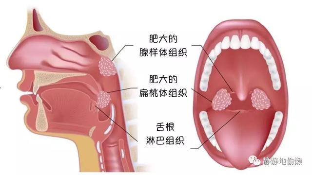 儿童腺样体的“收割”高峰已至，割还是不割？