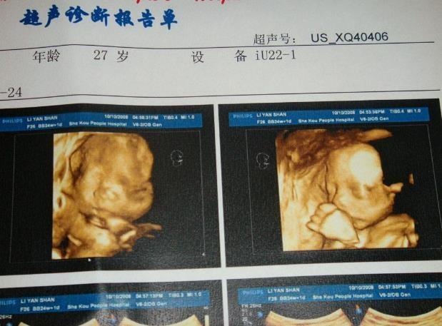 排畸检查，为什么要放在孕中期？孕晚期不应该看得更清楚吗？