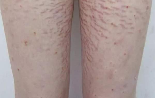 女子在妈妈群问诊后用“口碑好药” 女儿浑身长黑毛