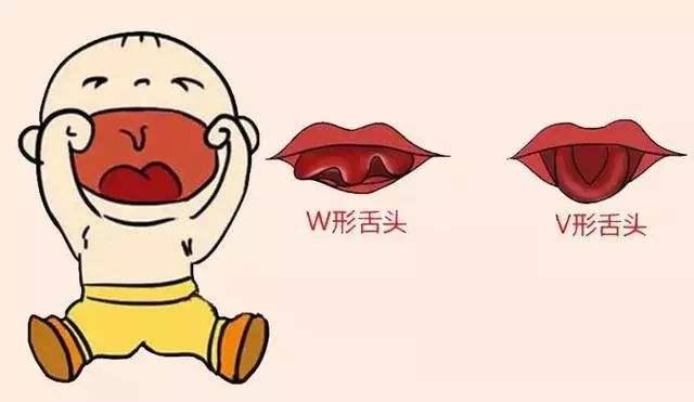 宝宝“大舌头”原来是舌系带过短！舌筋该不该剪？能自愈吗？