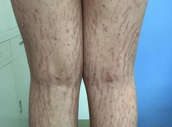 女子在妈妈群问诊后用“口碑好药” 女儿浑身长黑毛