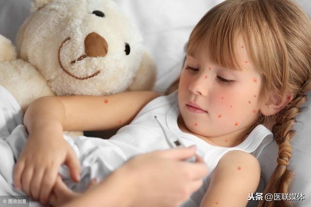 怎么判断是不是水痘？“瞄准”这3个迹象，一出现就去治