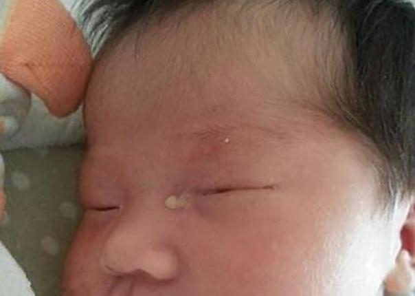 6个月女童总爱流泪，医生将针扎入眼角，流出的液体让妈妈吓坏了