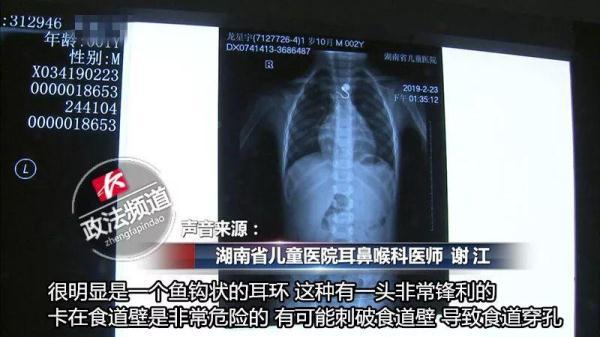 妈妈低头换尿布，1 岁多儿子吞下带钩珍珠耳环，卡在食道……