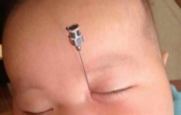 6个月女童总爱流泪，医生将针扎入眼角，流出的液体让妈妈吓坏了
