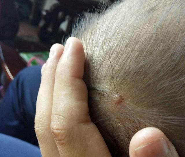 孩子睡觉老是摇头，头发都磨没了，到底是什么原因引起的？