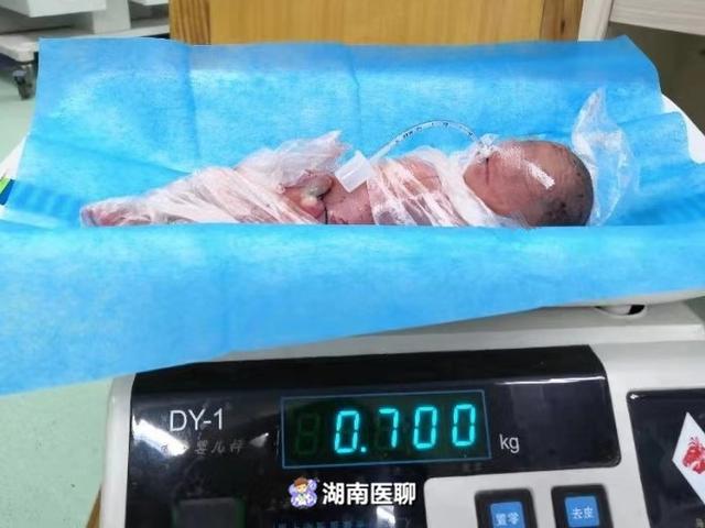 龙凤胎总体重不足3斤！一落地就进“鬼门关”，救治将持续四个月