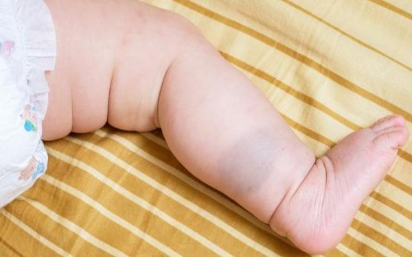 教你看宝宝身上的胎记,是不是有害?这3种胎记,家长务必注意