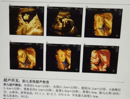 孕妈做“四维彩超”之前，最好了解3件事，多花冤枉钱