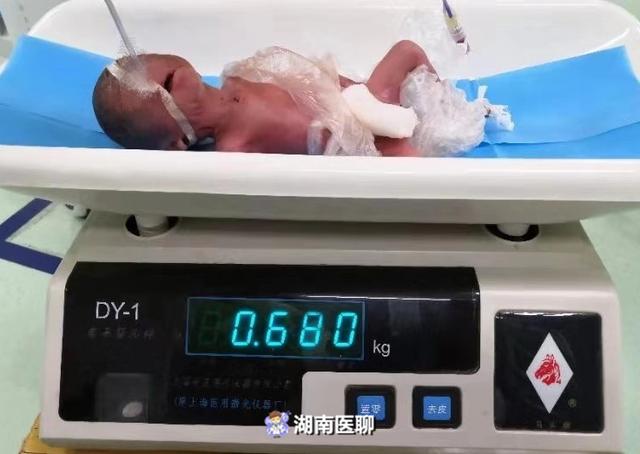 龙凤胎总体重不足3斤！一落地就进“鬼门关”，救治将持续四个月
