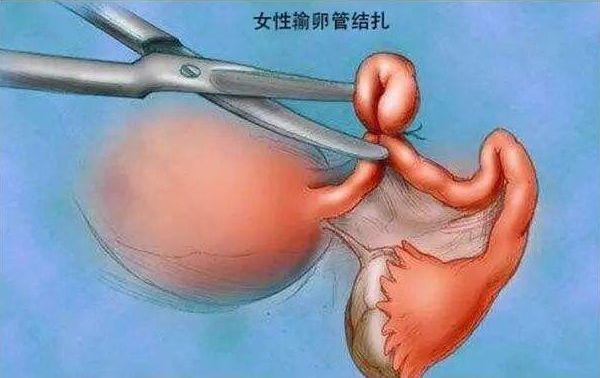 婆婆称剖腹产跟她当年结扎一样！没啥大不了，剖腹产真的这么随意