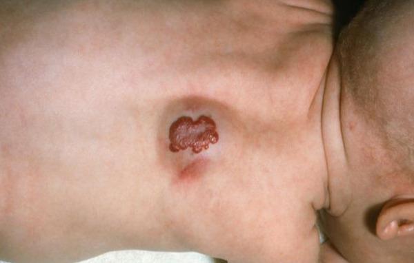 教你看宝宝身上的胎记,是不是有害?这3种胎记,家长务必注意