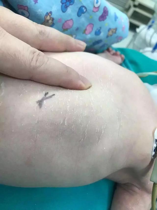 为保命，孩子刚出生4天，就要放弃半个肝脏！