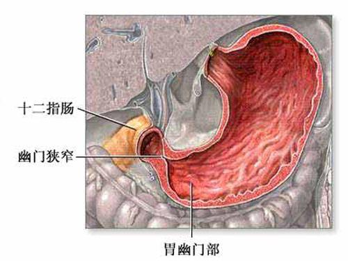 男孩嘴含铁球玩，咕噜一声咽了！家长卫生间连盯4天，球没找着…