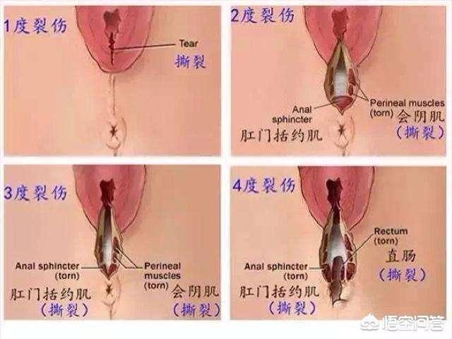 顺产一度撕裂有内缝针，1个月后表皮有一点缺口，这正常吗？还能愈合吗？