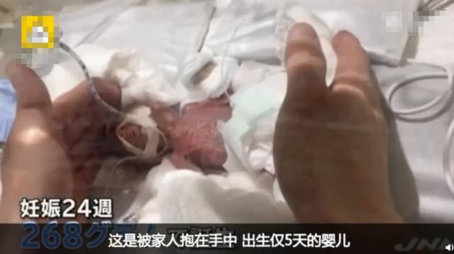 世界上最小的男婴平安出院，出生时仅268克