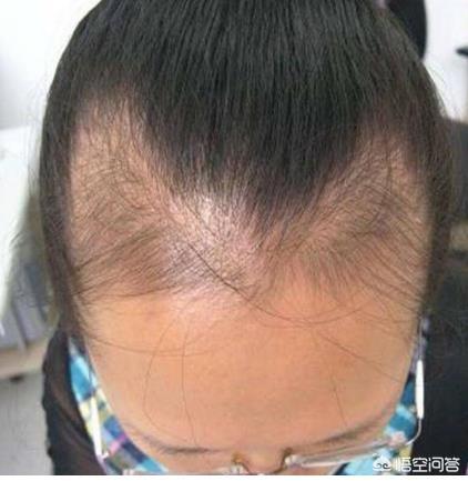 大部分女人生完孩子会掉头发，这是为什么？