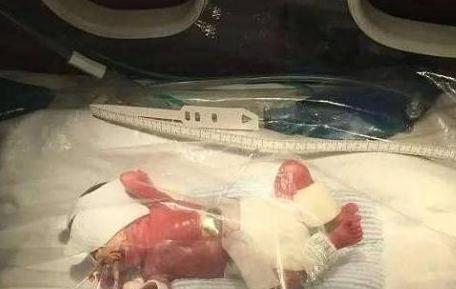 21岁妈妈已经有了三个娃，个个都早产最早一个23周就出生