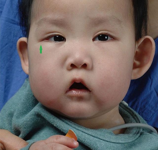 宝宝太漂亮也是病？“歌舞伎面谱综合征”，产检查不出的罕见病