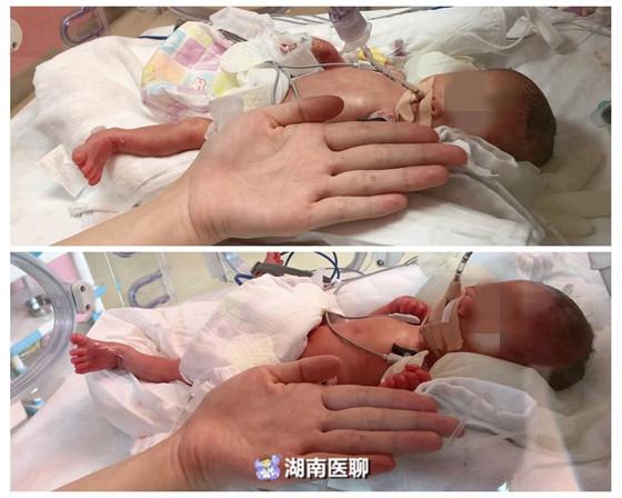 早产龙凤胎“生存记”：出生仅巴掌大！2个月连闯多个生命关逆袭