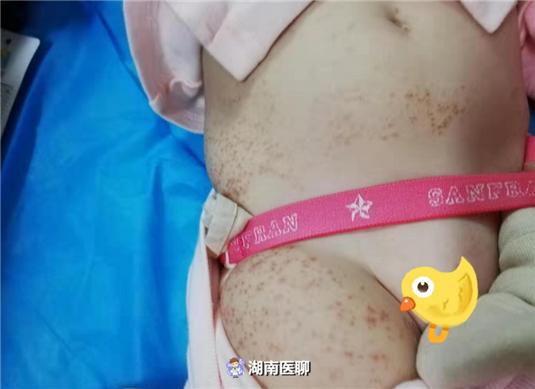 10月大宝宝被妈“坑”：用“黄酒”擦身治呕吐，全身长红疹还呕血