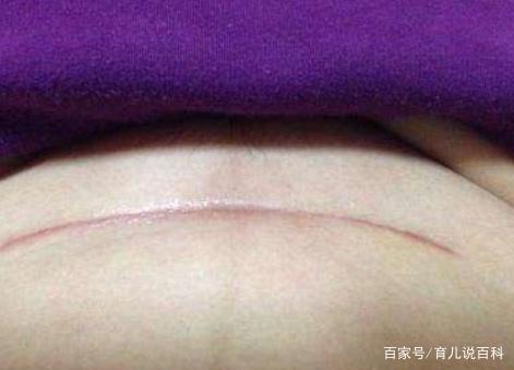 疤痕体质究竟怎么样？剖腹产后，看肚子就知道了
