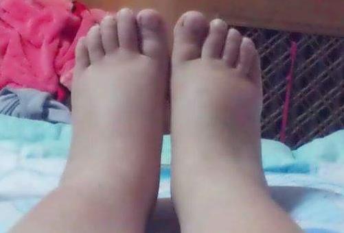 孕期水肿别担心，孕妈做好5件事，缓解水肿现象，促进胎儿发育