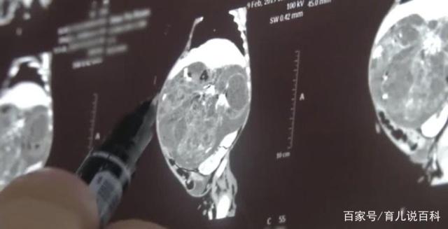 刚出生的女婴有6斤！发现女婴肚子不对劲，父母连夜带孩子去医院