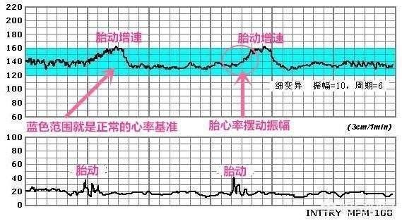 胎儿宫内缺氧后果很严重，怎样才能知道胎儿是否宫内缺氧呢？