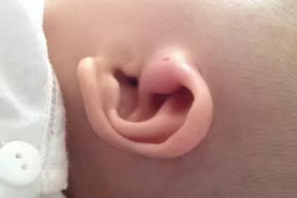 孩子耳朵有“孔”，就能大富大贵？清醒点，也有可能是疾病的征兆
