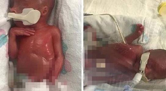 早产双胞胎出生时每个只有1斤多点，如今刚过完1岁生日都很健康