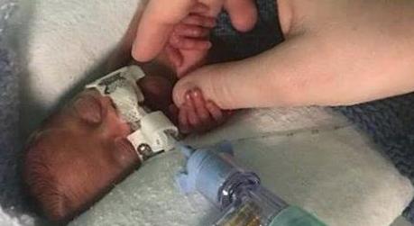 早产双胞胎出生时每个只有1斤多点，如今刚过完1岁生日都很健康