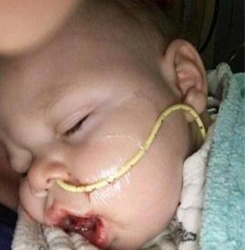 男孩舌头异常肥大险些致命，手术成功终于能叫妈妈！