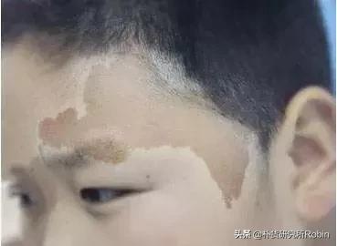 孩子身上有这6种胎记，要出事！