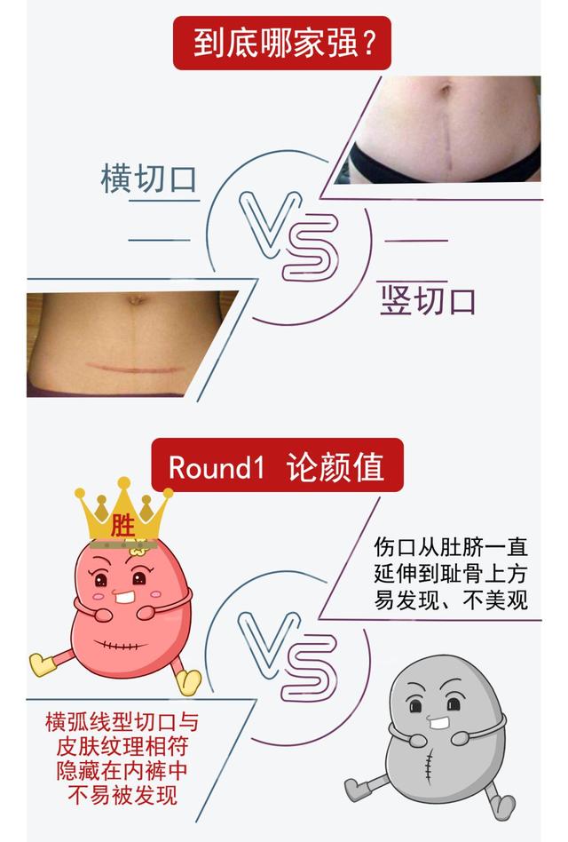 剖宫产这一刀在哪划？划多大？怎么缝？都是很有讲究的