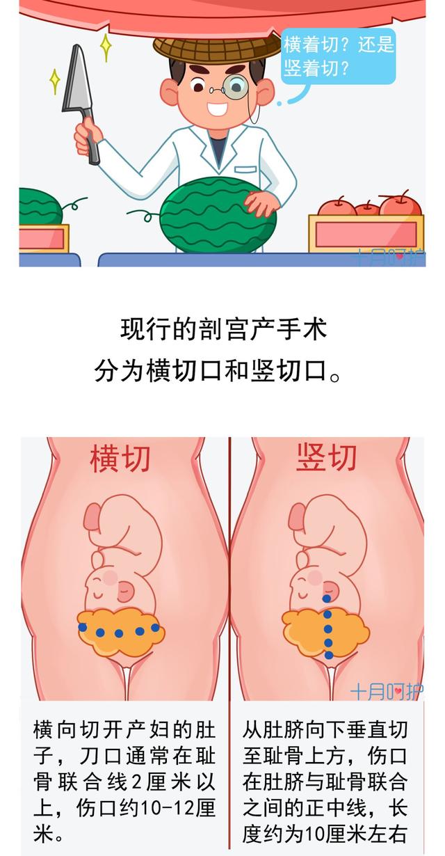 剖宫产这一刀在哪划？划多大？怎么缝？都是很有讲究的