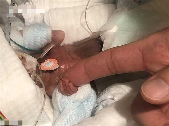 “世界最小男婴”出生时仅5个鸡蛋重，一年后，他的变化令人感叹