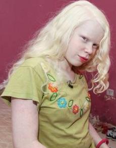 纯非洲父母却生出了三个白皮肤的孩子，常被误认为是人贩子