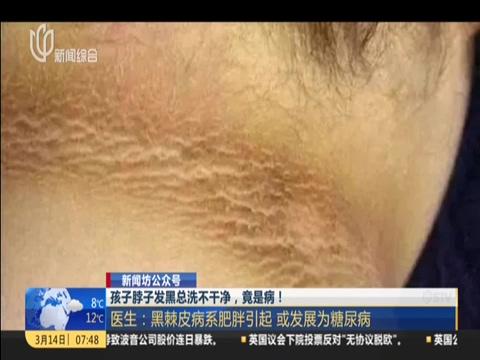 孩子脖子发黑总洗不干净，竟是病！医生：患病儿童日剧增加