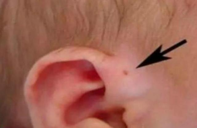 孩子生来耳朵上就有小孔，是怎么回事？家长要心中有数，别忽视了