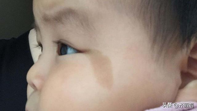 “胎记”不仅受到基因影响，还可能是孕期里的这3大行为导致