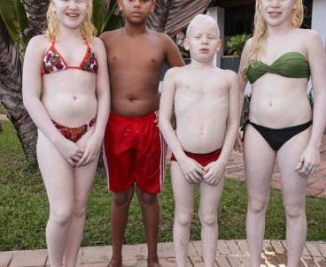 纯非洲父母却生出了三个白皮肤的孩子，常被误认为是人贩子