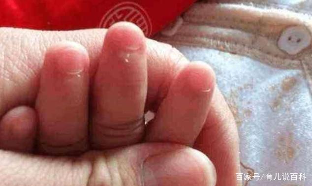 宝宝手上经常长倒刺，可能是身体缺了这个，妈妈别忽视了！