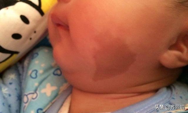 “胎记”不仅受到基因影响，还可能是孕期里的这3大行为导致