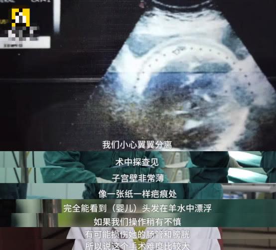 33岁女子10年经历4次剖宫产，疤痕破裂风险极高，手术有惊无险