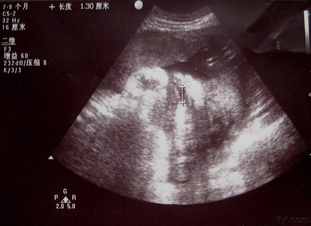 妊娠早期保养有多重要？预防胎儿畸形很有效，准妈妈都得了解