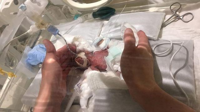 半斤的孩子竟然活下来了，产科医生了不起！