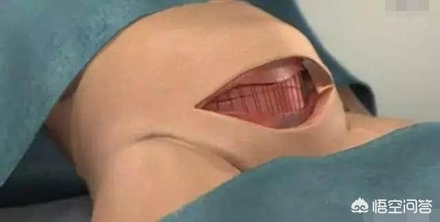 剖宫产要缝几层？