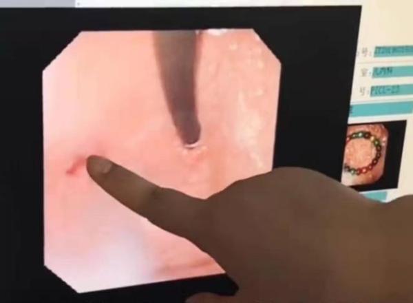 警惕!呼和浩特一2岁女童吞18颗磁力珠 在胃里连成串