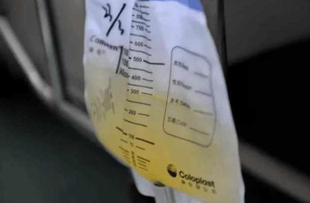 为啥剖腹产要插尿管？拔尿管后咋排尿？这些酸爽办法你试过几个